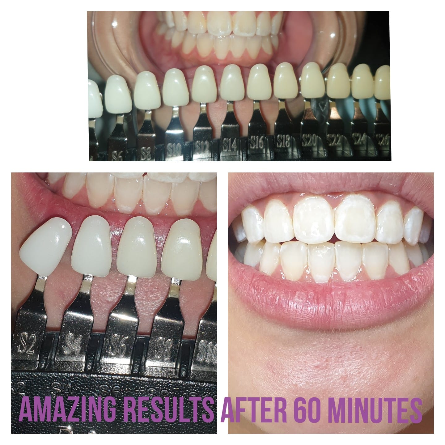 Teeth Whitening Envy Beauty Aesthetics
