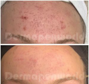 Acne_Female-1-3