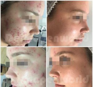 Acne_Female-6-3