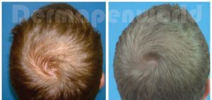 Alopecia-Male-6-2