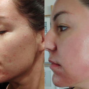 Algae Peel Before and After 1