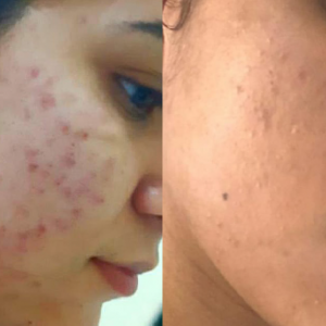Algae Peel Before and After 2