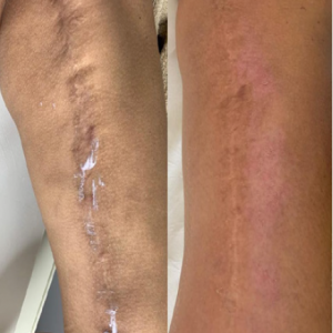 Algae Peel Before and After 3