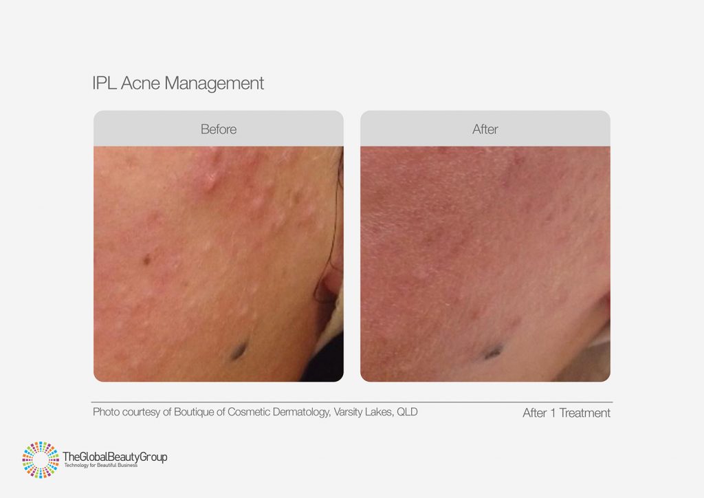 IPL_Acne_Management_Before_After_01