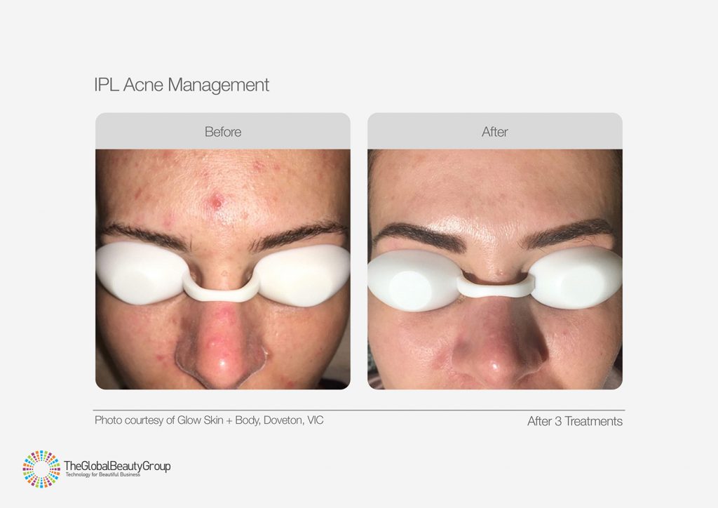 IPL_Acne_Management_Before_After_02