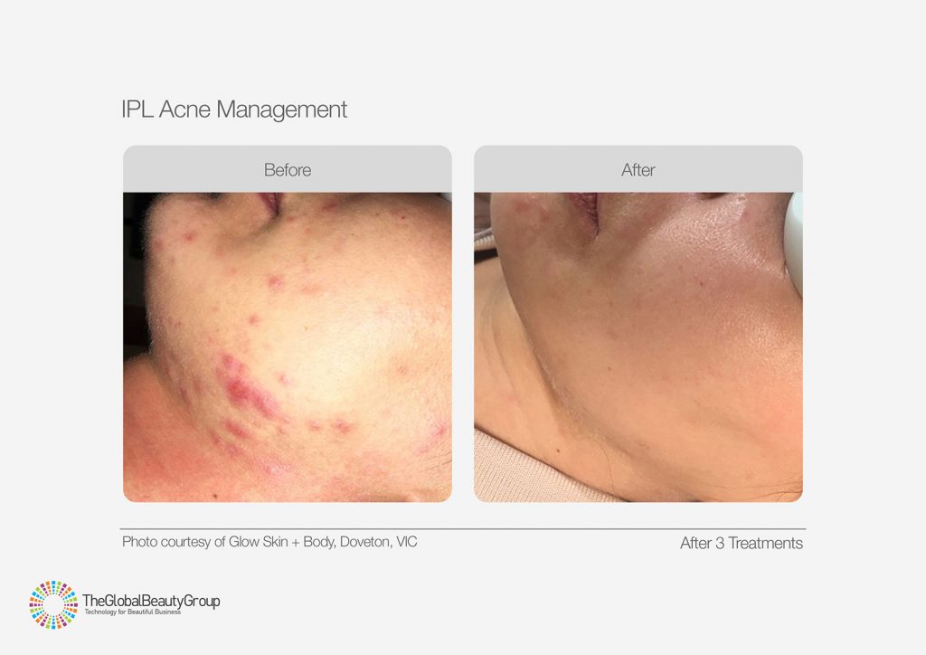 IPL_Acne_Management_Before_After_03