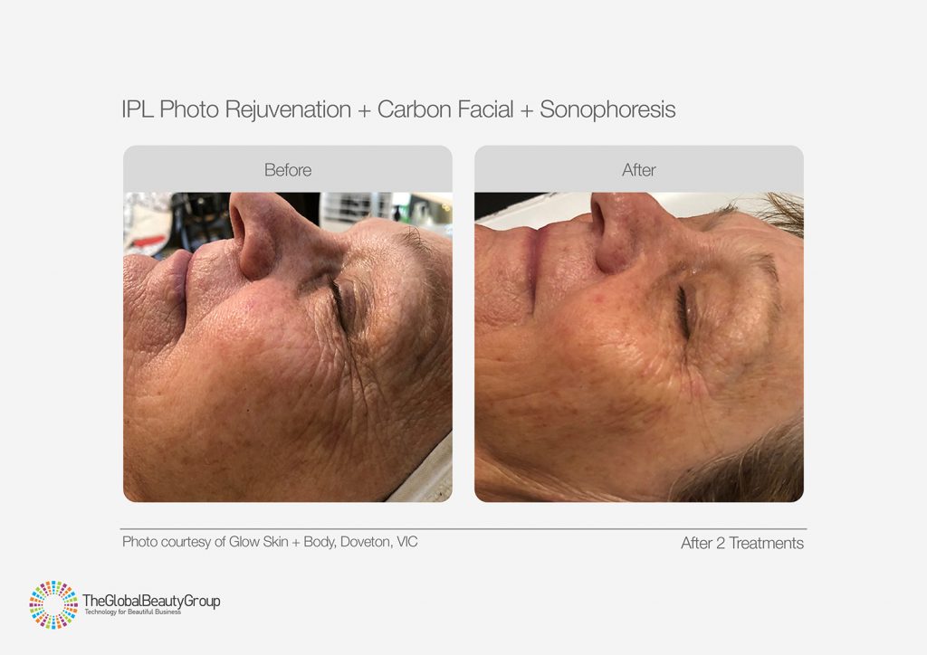 IPL_Photo_Rejuvenation_Before_After_01