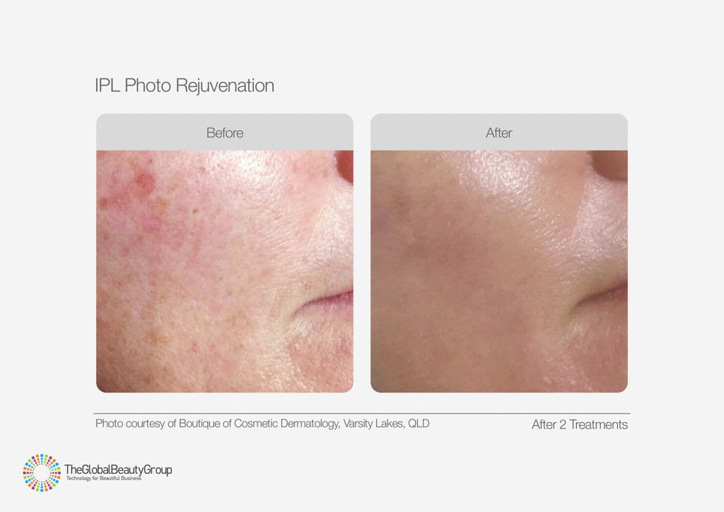 IPL_Photo_Rejuvenation_Before_After_03