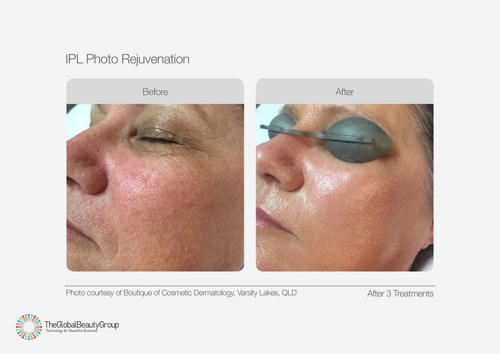 IPL_Photo_Rejuvenation_Before_After_04