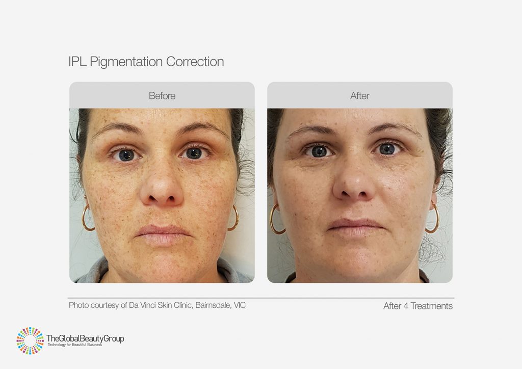 IPL_Pigmentation_Correction_Before_After_04