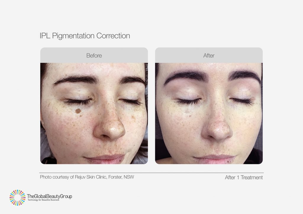 IPL_Pigmentation_Correction_Before_After_06