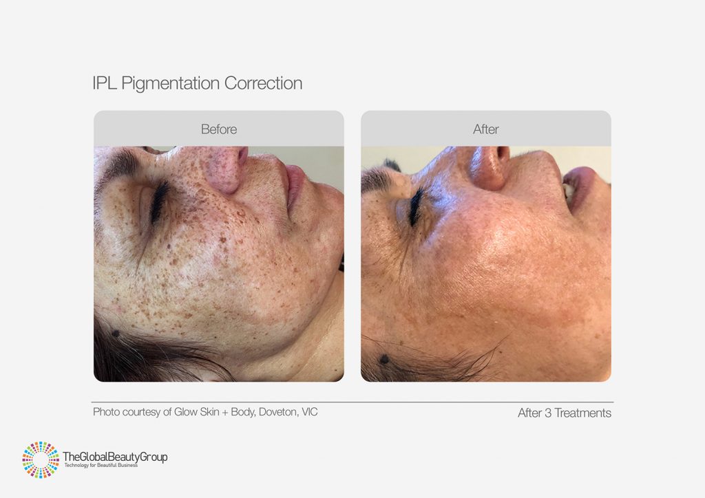 IPL_Pigmentation_Correction_Before_After_07