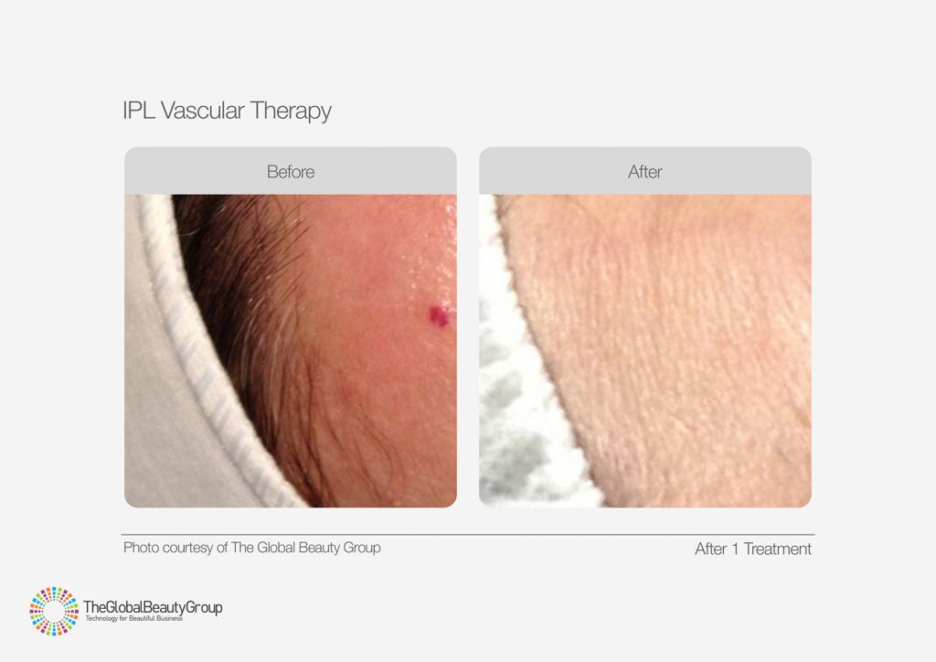 IPL_Vascular_Therapy_Before_After_06