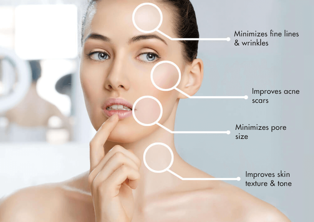 Skin Needling & Mesotherapy - Envy Beauty Aesthetics