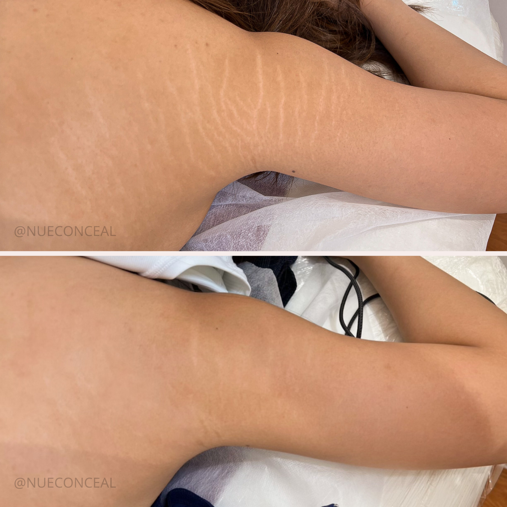 Does The Inkless Stretch Mark Technique Work  Reflective Beauty Boutique