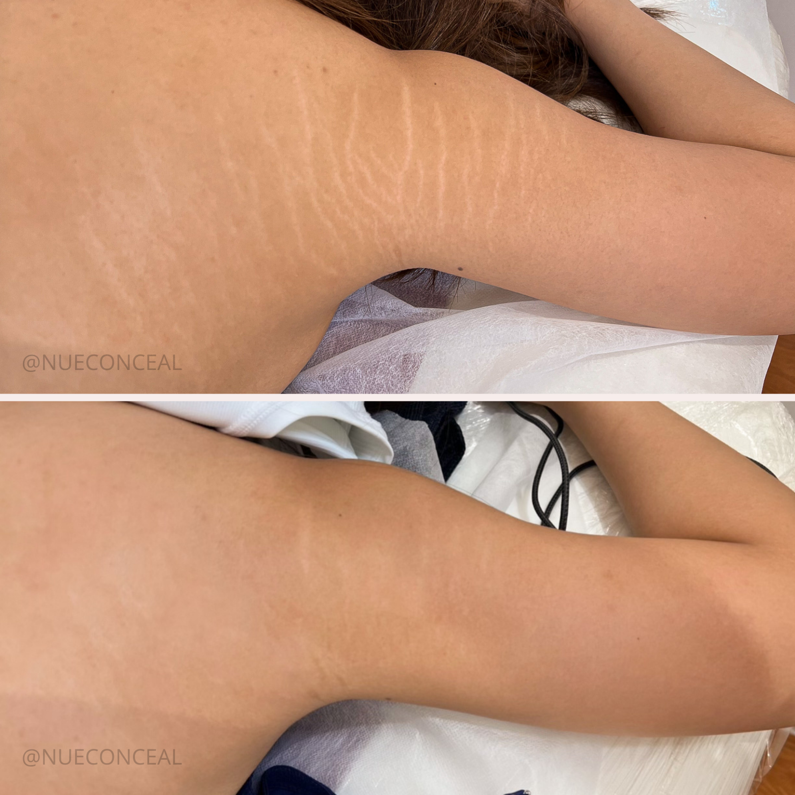 Stretch Mark Removal & Treatment Sydney